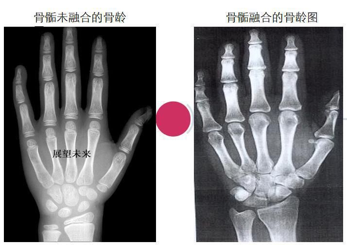 一张表教你看孩子是否身材矮小！越早治疗越好，千万别等到青春期