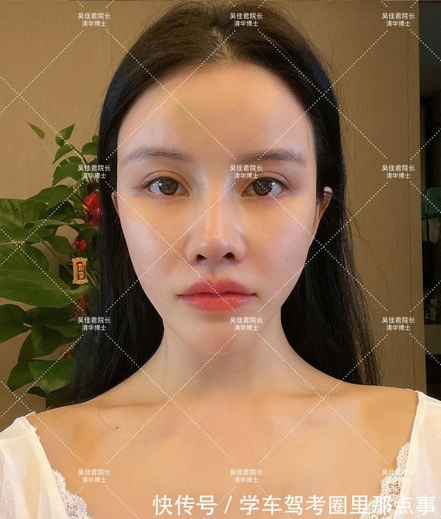 法令纹 32岁姑娘小拉皮术后7个半月,变得年轻又精致,前后反差很大!