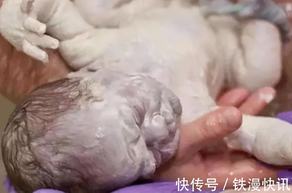 医生|90后宝妈诞下“雪人宝宝”,宝爸吓得不敢抱娃,医生恭喜了
