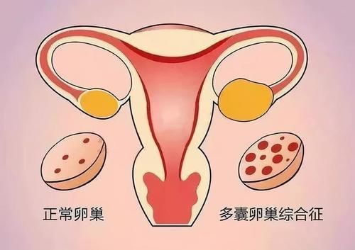 肥胖|减肥30斤，多囊也消失了！5个关键方法，帮她重新备孕