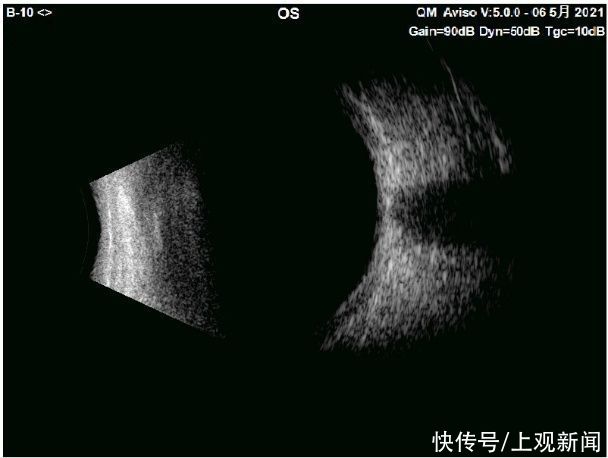 b超|眼外伤不可怕，重见光明有希望