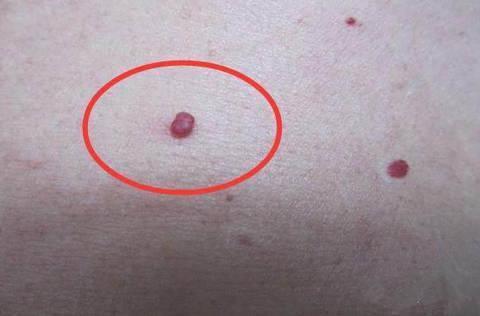 黄曲霉毒素|身体出现“小红点”，八成是肝喊疼了，忠告要忌口