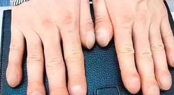 中指|手有这“4种变化”,提醒你“大病”来了,需尽早就医,千万别拖