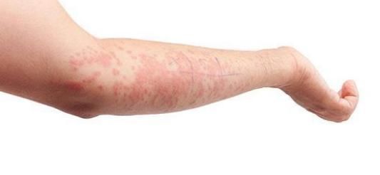 药草|蒲公英被称为“药草皇后”,常吃有什么好处?医生:1类人少吃!