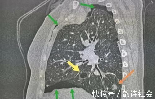 胸膜|癌症病人的幸运指数不一样，这位老太太想感谢一个吹破的肺大泡