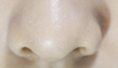 打呼噜|秋季防鼻炎：注意4个症状，做好2件事，过敏性鼻炎难复发