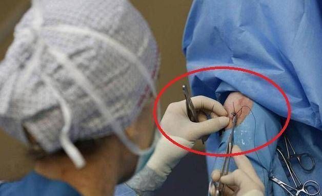 缝合|90后孕妈生下双胞胎刚要缝合,突然大喊“别动”,医生当场被吓懵