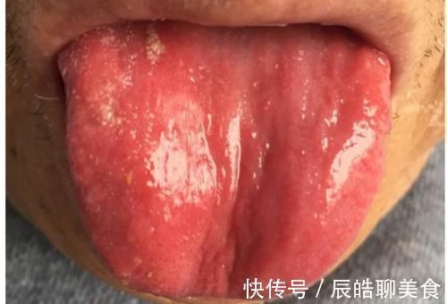 糖尿病|80后精神小伙患2型糖尿病,医生感叹太年轻,5种舌象很常见要当心