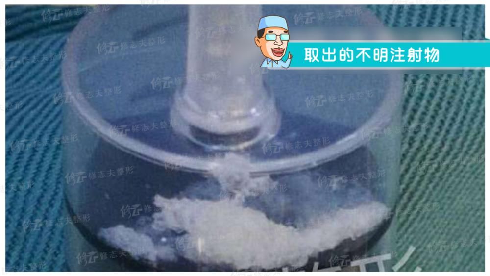  鼻尖|鼻修复时取出的东西都有啥？感受一下！