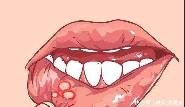 溃疡|你从来没有见过的一个疾病,用这个方子治疗,经常溃疡的人收好