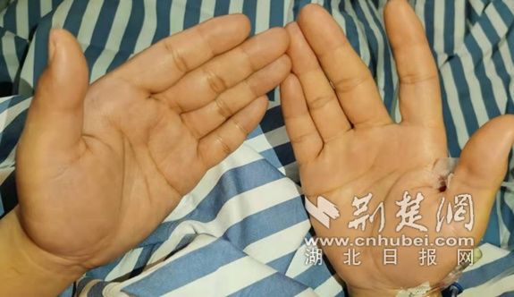  手汗症|小伙手掌常年“汗如雨下”一台胸腔手术解决困扰