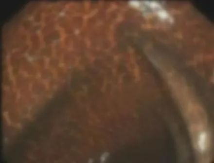 便秘|热搜第一！一女子的检查报告吓坏网友