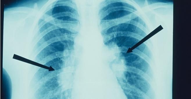 止咳|肺气肿中医如何治疗2个中药方,帮你化痰,止咳,补肺