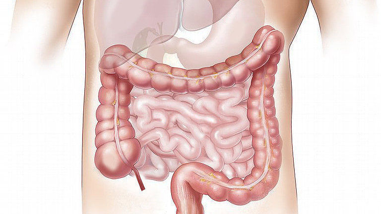 靶向治疗|结直肠癌危险系数高,医生:早发现仅需内镜治疗