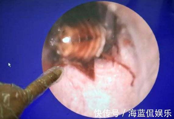 堪称教科书|2岁宝宝半夜耳朵进虫,奶奶用一招救了娃,医生堪称教科书典范