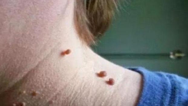 身体|脖子上长出了“小肉粒”是什么也许是身体向你发出的“暗号”