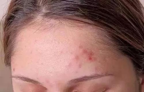 为什么你的痘痘永远反反复复消不下去?爆痘女孩必看