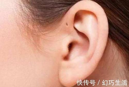 宝妈|为啥有些新生儿耳朵有小孔?医生一般不会主动讲,家长心里要有数