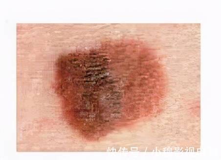 黑痣|身上出现4个小变化,当心肝癌、乳腺癌盯上你!洗澡时看一眼、摸一下能救命