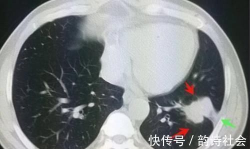 胸膜|癌症病人的幸运指数不一样，这位老太太想感谢一个吹破的肺大泡