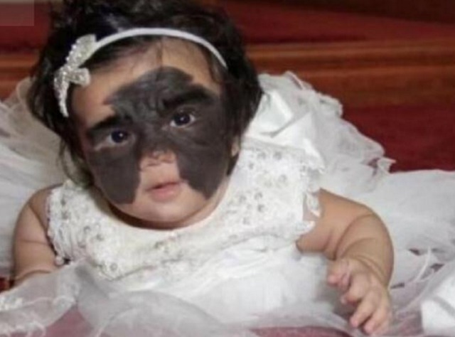 整容|“蝙蝠侠宝宝”火了,美国夫妇将她送去整容祛除胎记,后来怎么样