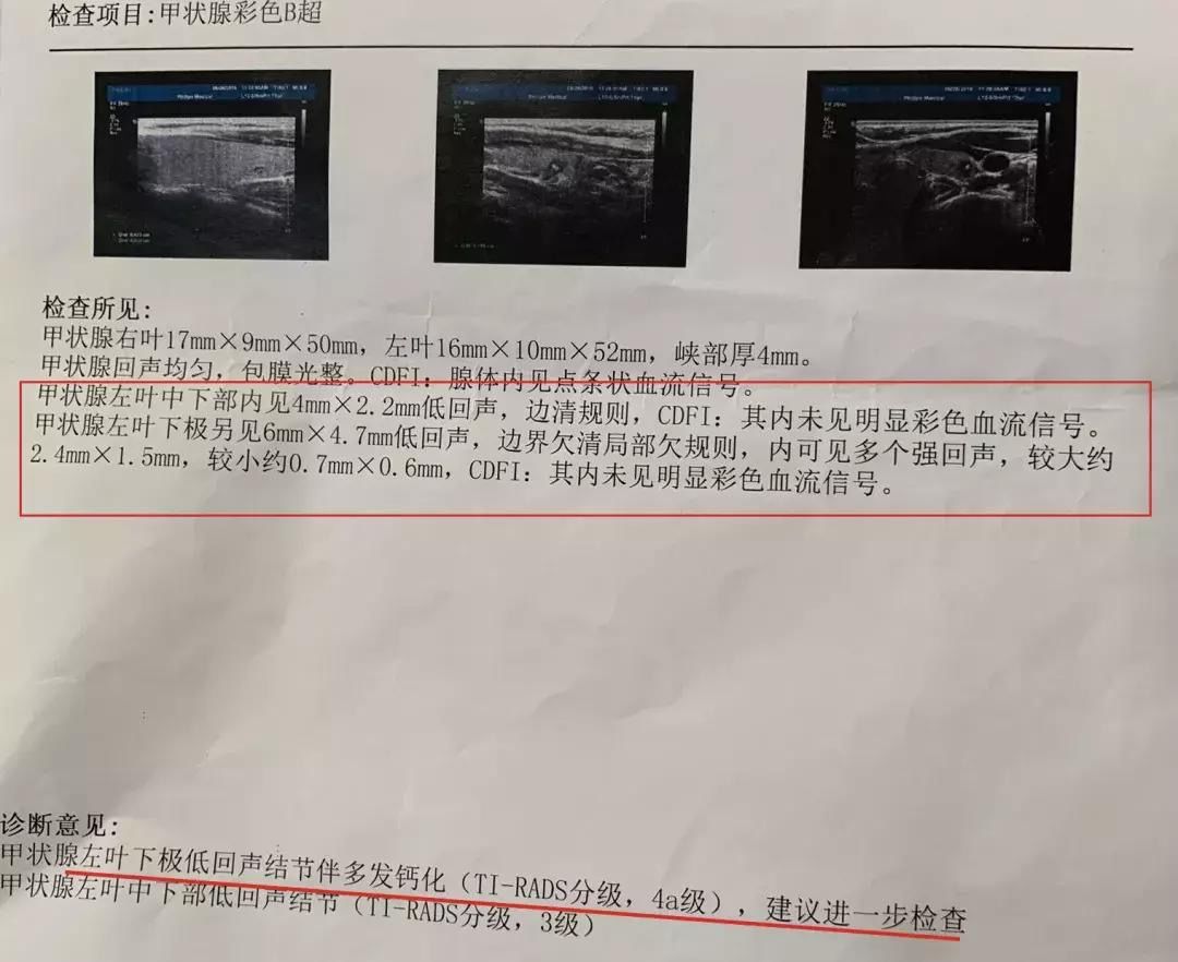 前列腺钙化|体检报告中“钙化”常出现，哪些钙化勿担心？哪些钙化需警惕？