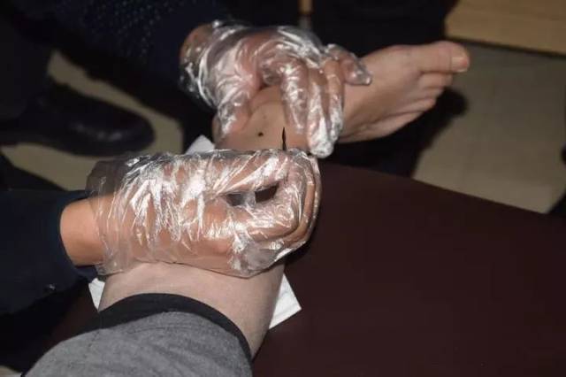 放血疗法|刺血不传之秘!20个最有用的针刺处方和25个放血疗法!赶紧收藏