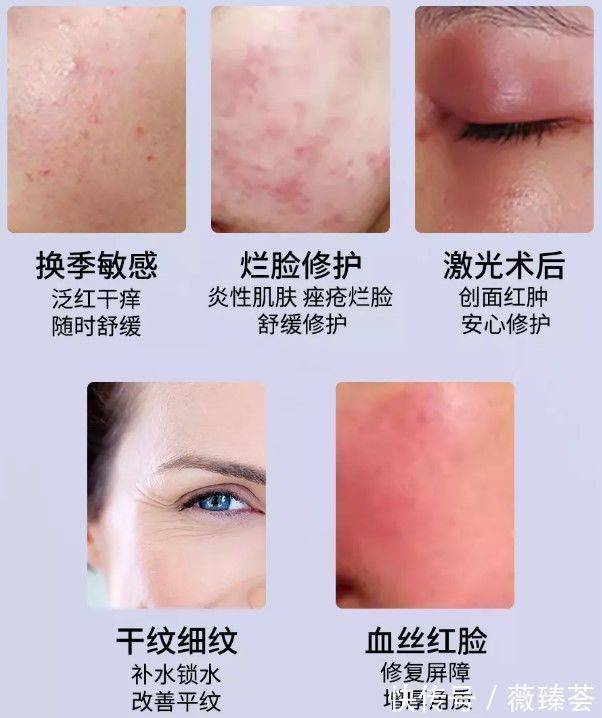 敏感肌肤修护：打造温和护肤新时代