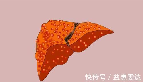 疼痛|肩膀疼痛當作是肩周炎，卻查出肝癌，醫生：伴隨2個癥狀，別忽略