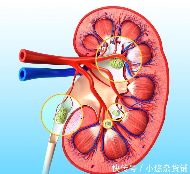  阶段|痛风分阶段，这4个阶段的痛风，你都了解吗？