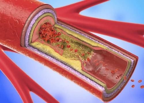 甘油三酯|想要稳定甘油三酯，中老年人尽量远离这3物要，早了解早受益