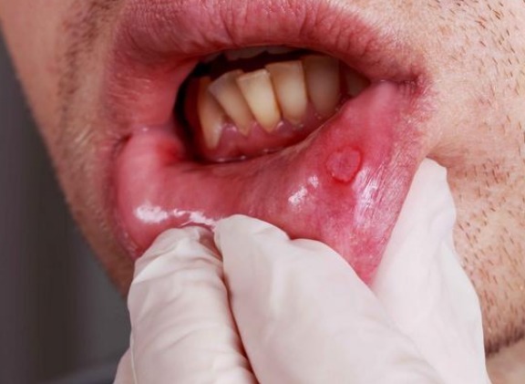 胆汁|“肝不好,嘴先知”!嘴巴若出现这些情况,说明肝脏八成出问题了