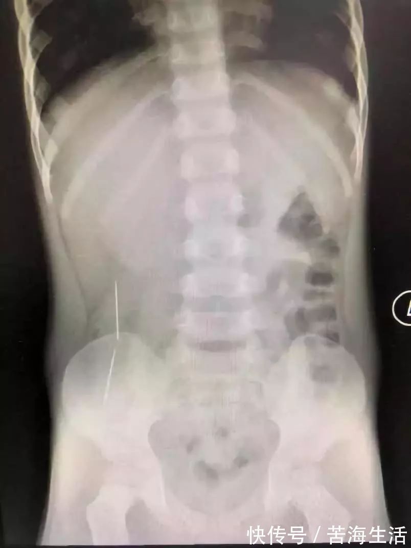 硬币|食管被烧黑!2岁娃来深紧急手术,只因吃下这东西!家里太常见