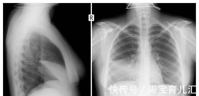 病灶|肺癌来临，身体会“说话”？这4个都可能是警告，别大意