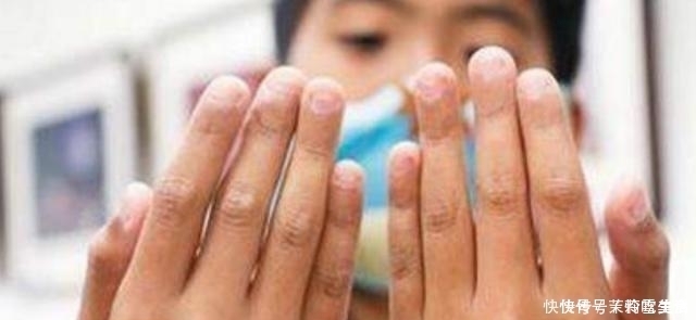 指甲|自小“咬指甲”的孩子,长大后怎么样了医生逃不掉2种结局