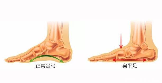 累,是懒吗?别冤枉孩子,先检查是不是扁平足