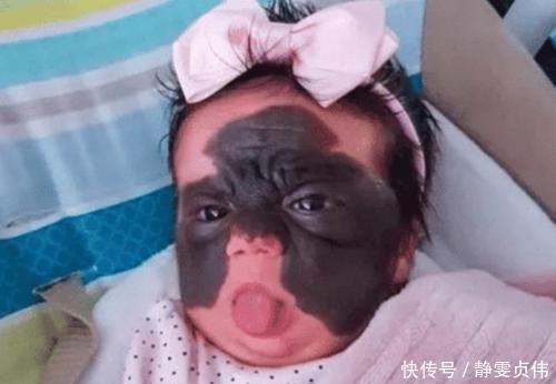 先天性|那个脸上有“蝙蝠”胎记的女孩，如今生活的怎么样？看完很欣慰