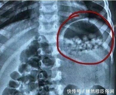 医生|2岁宝宝肚子差点胀破,医生查出肚里东西,爸爸妈妈差点受不了