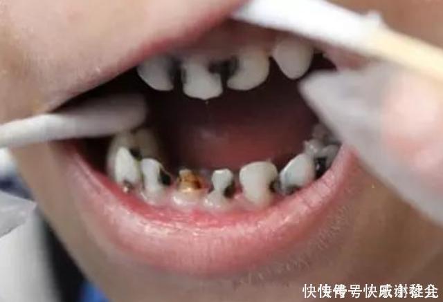 小米|3岁孩子满口蛀牙,妈妈却毫不在意说等换牙就好,医生怒斥无知