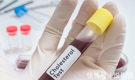 自救|发现自己血脂高怎么办?医生:4个方法可自救 ,早知道早好