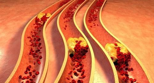 血管堵塞|血脂高，应远离豆腐？坦白说：除了豆腐，5种“素食”还请少吃点