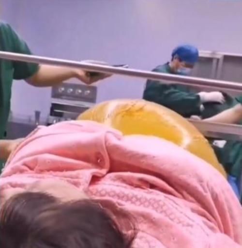 剖腹产|抗麻体质孕妇“生剖”双胞胎,哭声撕心裂肺,产房外丈夫泪如雨下
