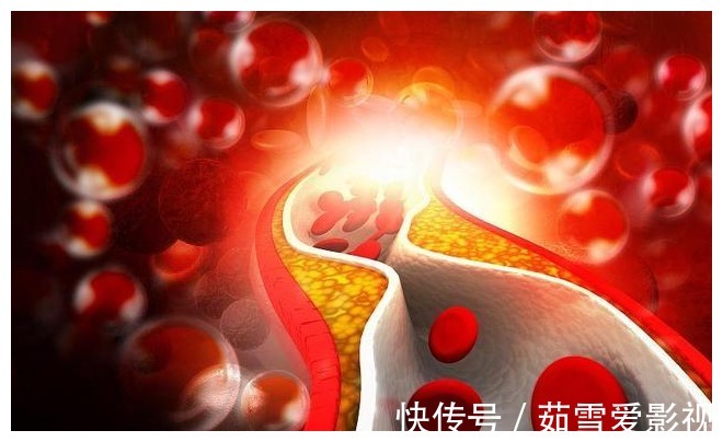 现象|双腿或是血脂的“晴雨表”?腿上出现这3种现象,血脂可能偏高了
