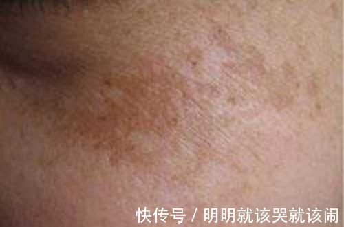 补血|一张治疗皮肤病的名方，黑眼圈、黄褐斑通通搞定，还能治疗妇科病