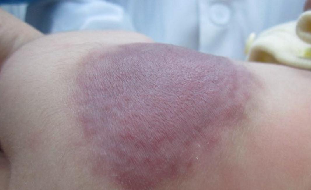 色素|孕期这些不以为然的习惯,或让宝宝带胎记出生,很多孕妈还在犯错