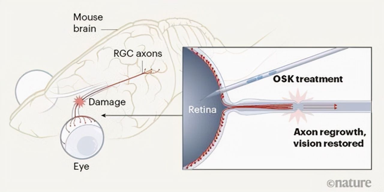 莱特维健|近视人群30亿?《Nature》公布:有望重编程视神经告别“四眼”
