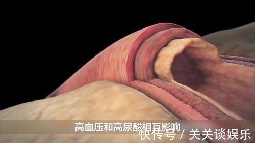 地平类药物|高血压合并高尿酸,常用降压药成“真凶”,用对1种药不患痛风