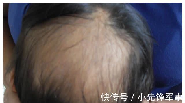 斑秃|娃的头发是发育的“标准”，发多发少家长要有数，关乎宝宝的健康