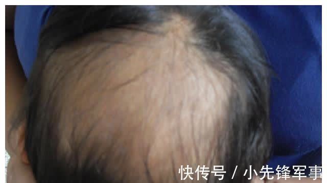 斑秃|娃的头发是发育的“标准”,发多发少家长要有数,关乎宝宝的健康