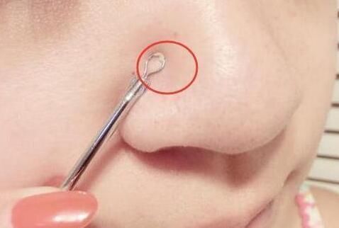 鼻子周围挤出白色米粒？为何医生不让挤？今天就给大家科普一下！